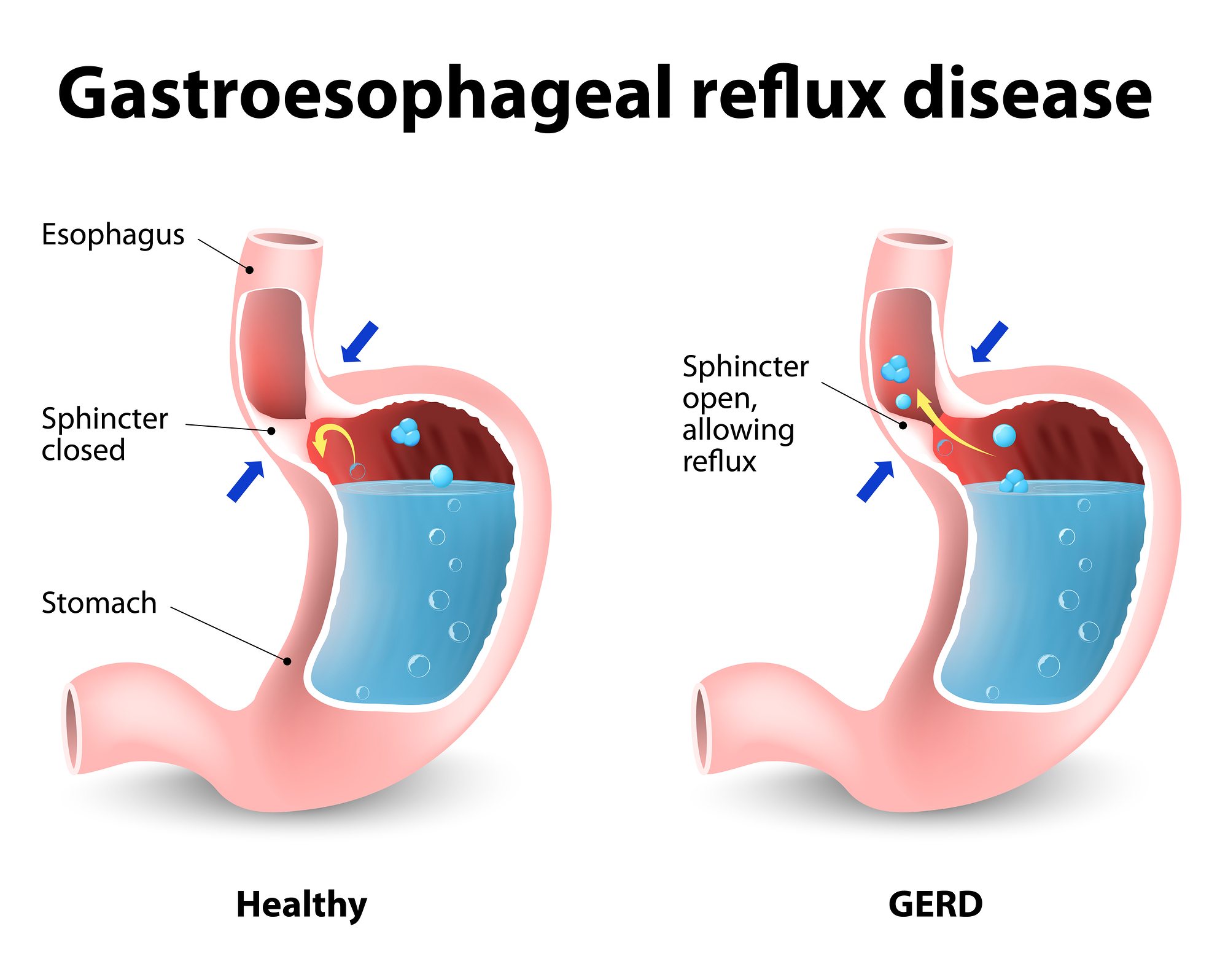What are the symptoms of an esophagus disease?